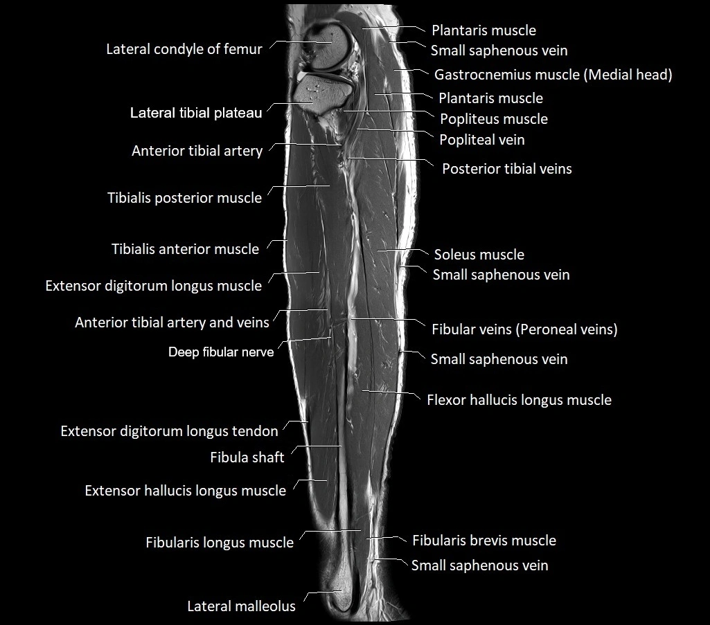 Lower leg sagittal anatomy 3T MRI image 12.webp